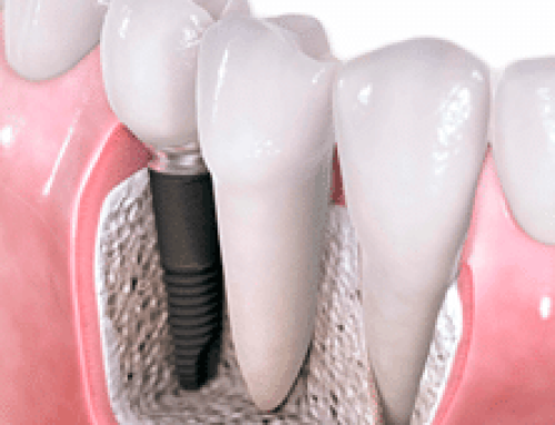 Todo sobre los implantes dentales