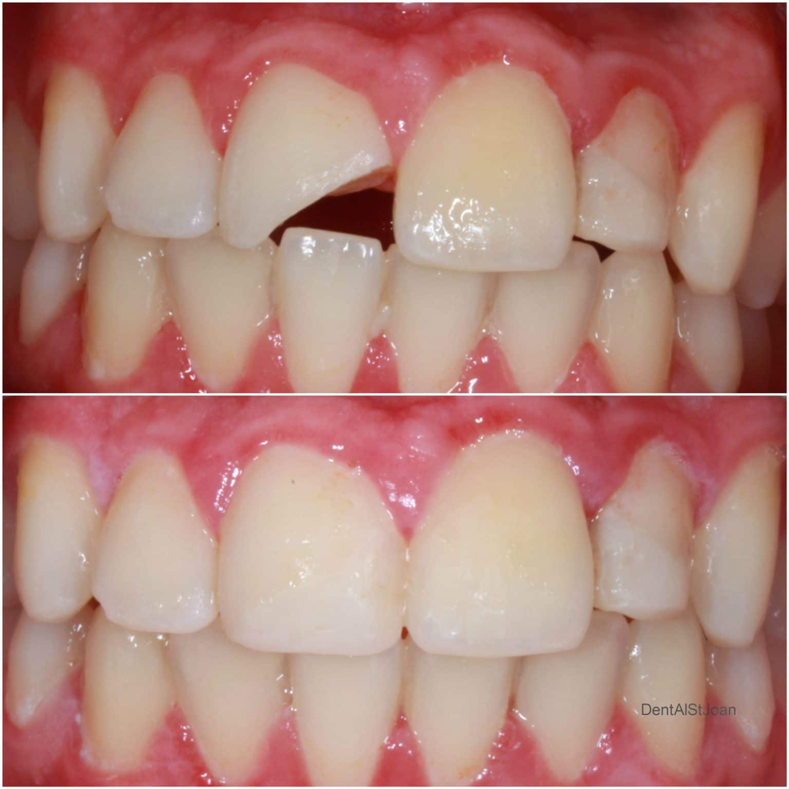 Lesiones Dentales En Deportistas - Dent Al, Clínica Dental Sant Joan Despí