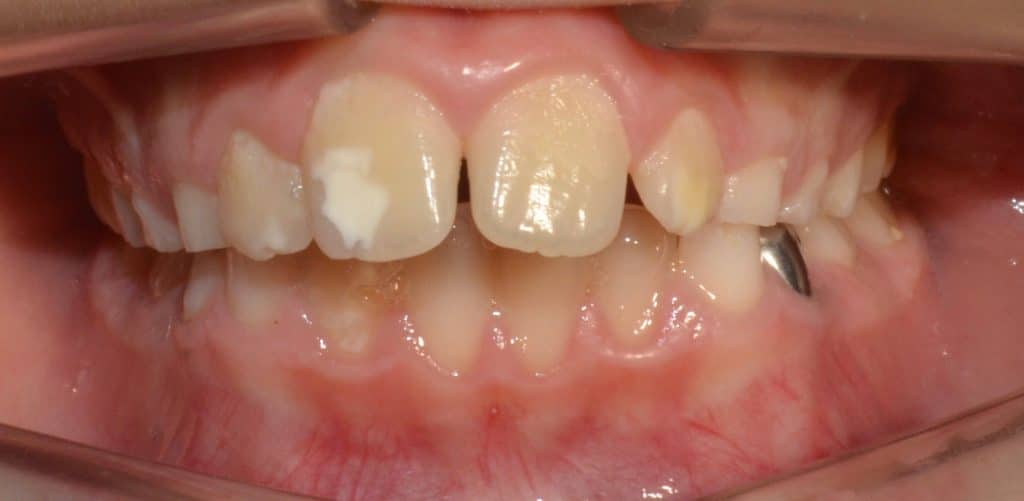 hipoplasia dental