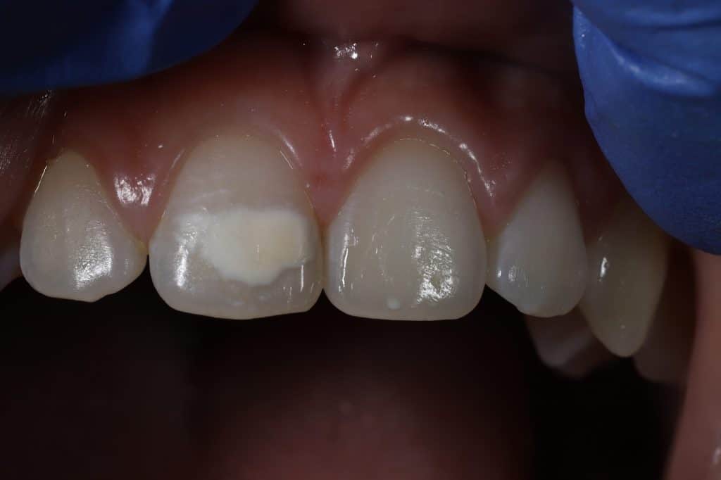 hipoplasia dental