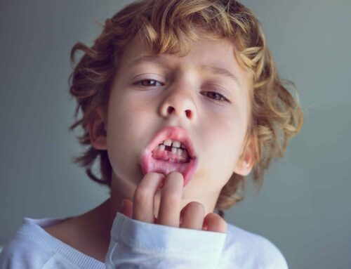Fracturas dentales infantiles y cómo actuar