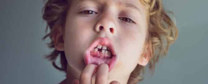 fracturas dentales infantiles
