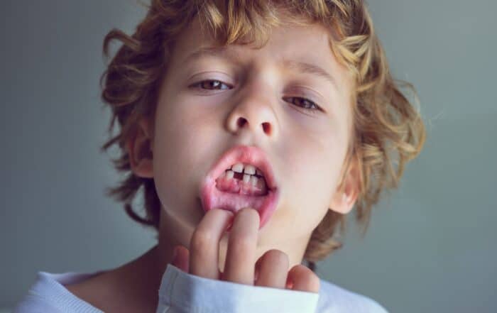 fracturas dentales infantiles