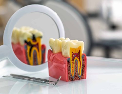 ¿Cuándo es recomendable cambiar un empaste dental antiguo?